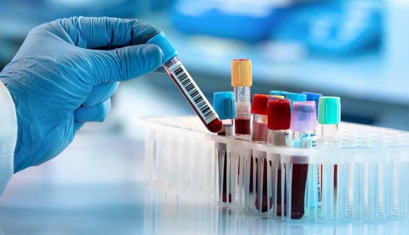 HIV, Hepatitis und Tuberkulose können kontrolliert werden: Ukrainern wird geraten, kostenlose Tests durchzuführen